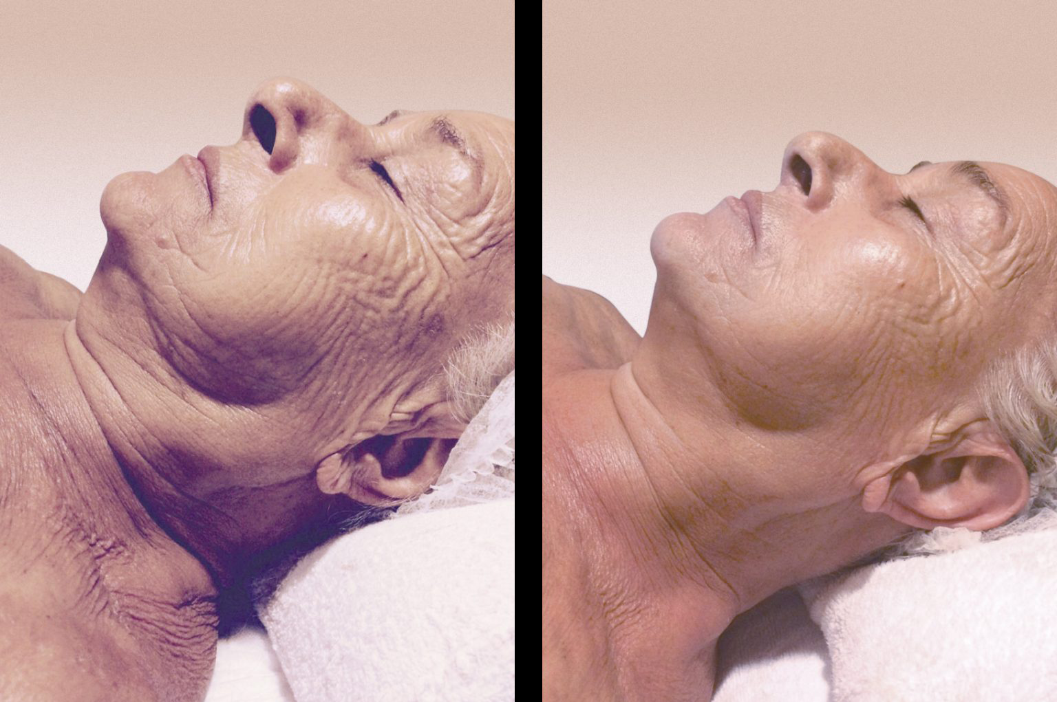 Foto del antes y después de una sesión de radiofrecuencia facial INDIBA en un hombre adulto